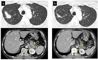 Repeating late-phase pseudo-progression in a patient with non-small cell lung cancer treated with long-term nivolumab monotherapy; a case report